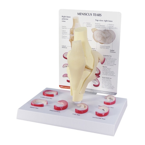 Knee with Meniscus Tears