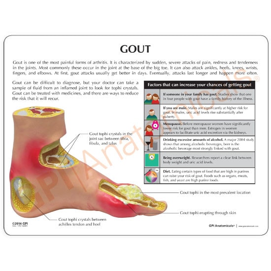 Foot with Gout Anatomy Model - front