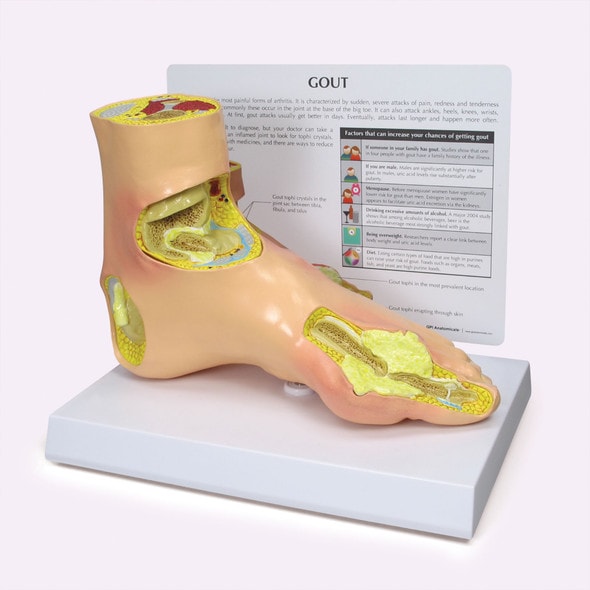 Foot with Gout Anatomy Model