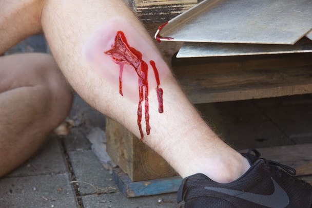 Skin Moulage, Laceration Wound