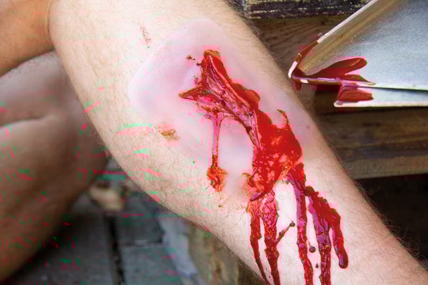 Skin Moulage, Laceration Wound