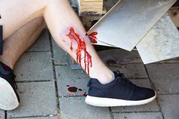 Skin Moulage, Laceration Wound