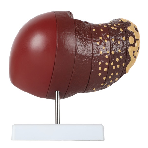 Axis Scientific Life-Size Human Liver with the Progression of Liver Disease