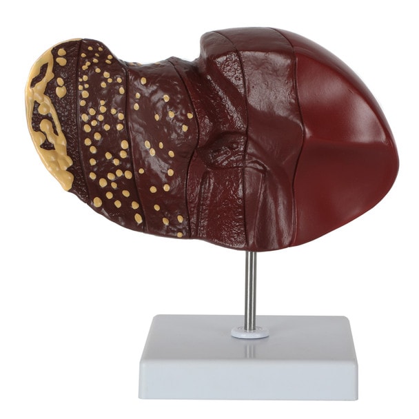 Axis Scientific Life-Size Human Liver with the Progression of Liver Disease