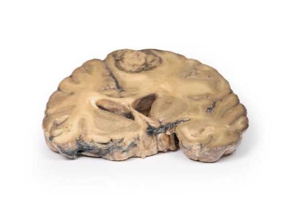3D Printed Metastatic Adenocarcinoma in the Brain