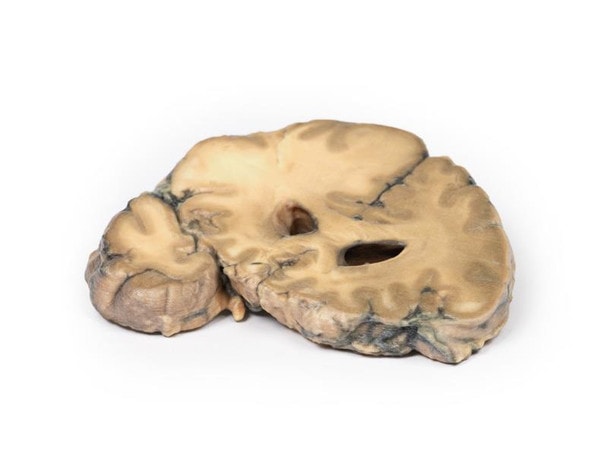 3D Printed Metastatic Adenocarcinoma in the Brain