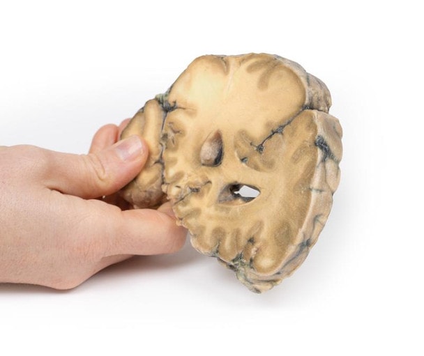 3D Printed Metastatic Adenocarcinoma in the Brain