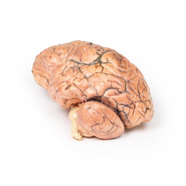3D Printed Craniopharyngioma