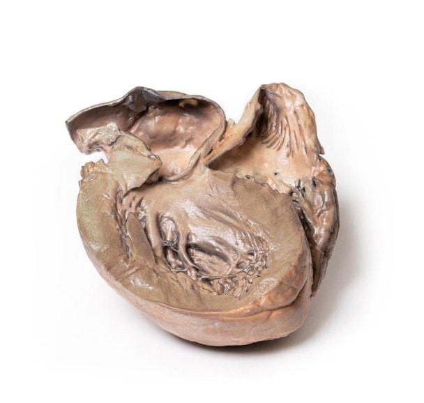 3D Printed Ruptured Thoracic Aortic Aneurysm