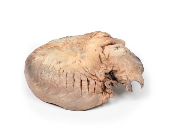 3D Printed Ruptured Thoracic Aortic Aneurysm