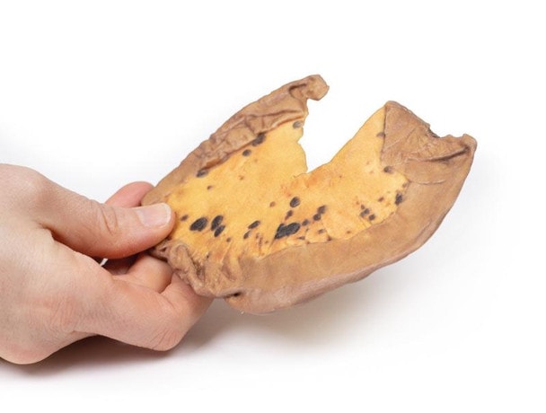 3D Printed Mesenteric Metastases from Cutaneous Malignant Melanoma