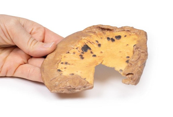 3D Printed Mesenteric Metastases from Cutaneous Malignant Melanoma