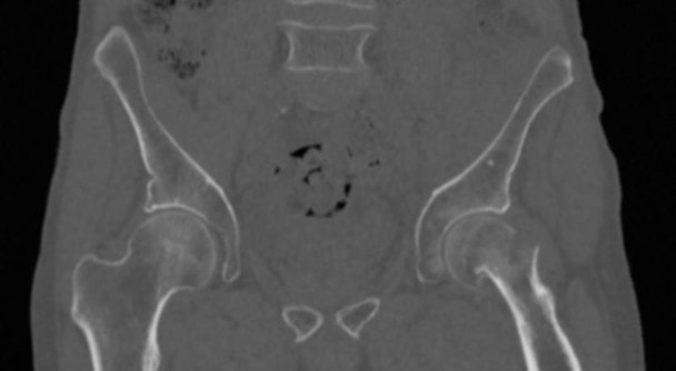 Pelvic Phantom with Femoral Neck Fracture for CT, X-Ray and Radiation Therapy