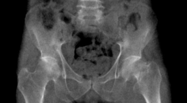 Pelvic Phantom with Femoral Neck Fracture for CT, X-Ray and Radiation Therapy