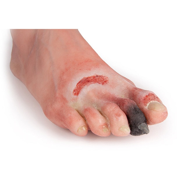 Wound Foot with Diabetic Foot Syndrome