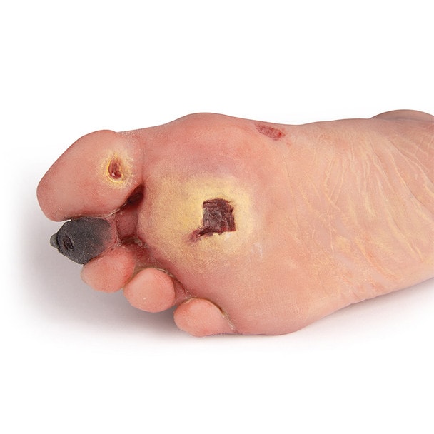 Wound Foot with Diabetic Foot Syndrome