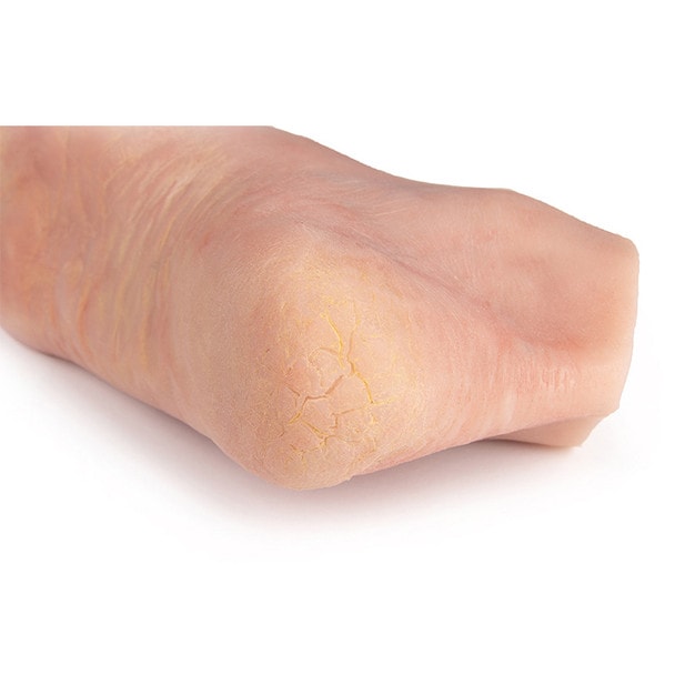 Wound Foot with Diabetic Foot Syndrome