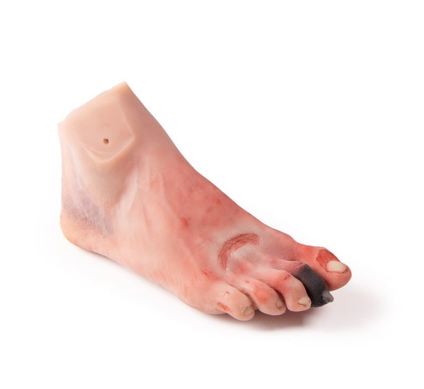 Wound Foot with Diabetic Foot Syndrome