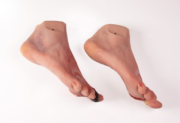 Wound Foot with Diabetic Foot Syndrome