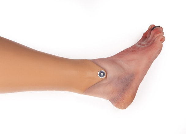 Wound Foot with Diabetic Foot Syndrome