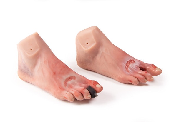 Wound Foot with Diabetic Foot Syndrome