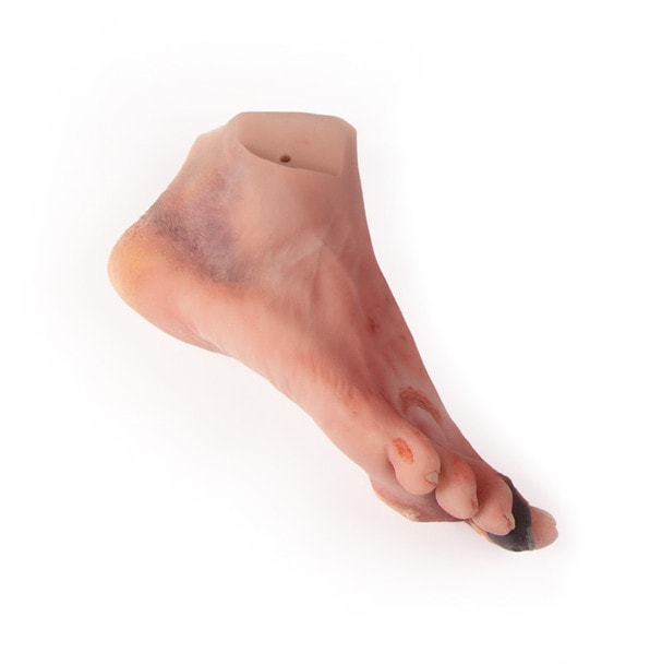Wound Foot with Diabetic Foot Syndrome