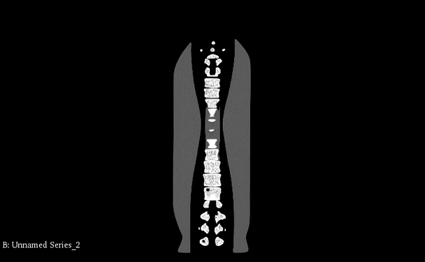 Adult Spine Phantom Model - CT scans