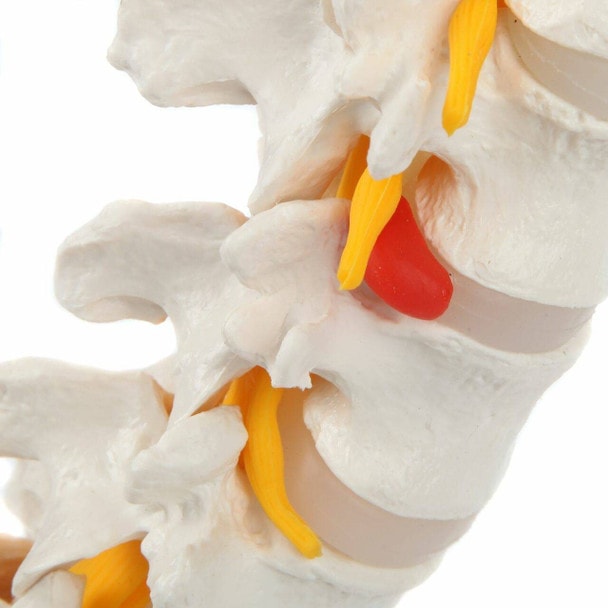 Axis Scientific Lumbar Vertebral Column with Sacrum and Spinal Nerves Anatomy Model Herniatic Disc