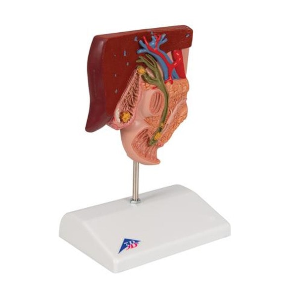Gallstone Anatomy Model