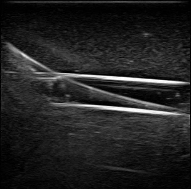 Gen II PICC with IV and Arterial Line Vascular Access Ultrasound Trainer