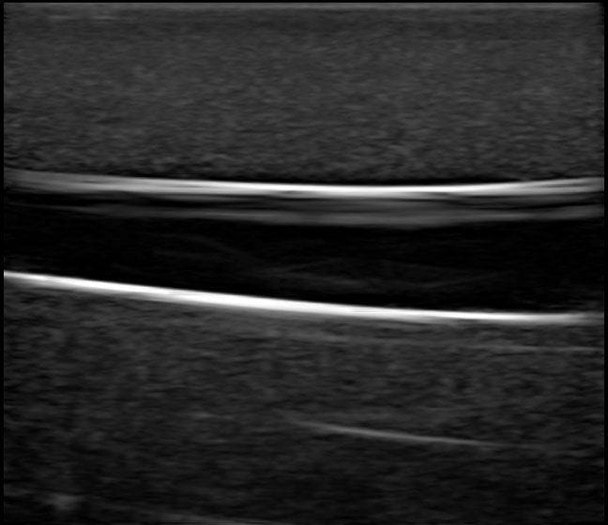 Gen II PICC with IV and Arterial Line Vascular Access Ultrasound Trainer
