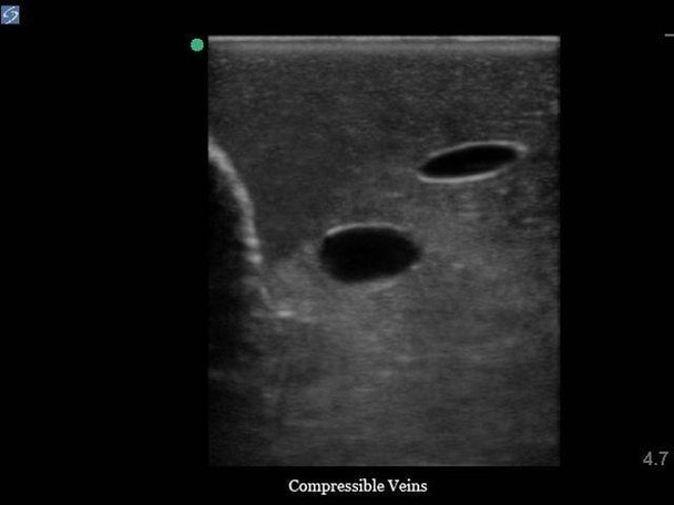 Gen II Ultrasound Central Line Training Model