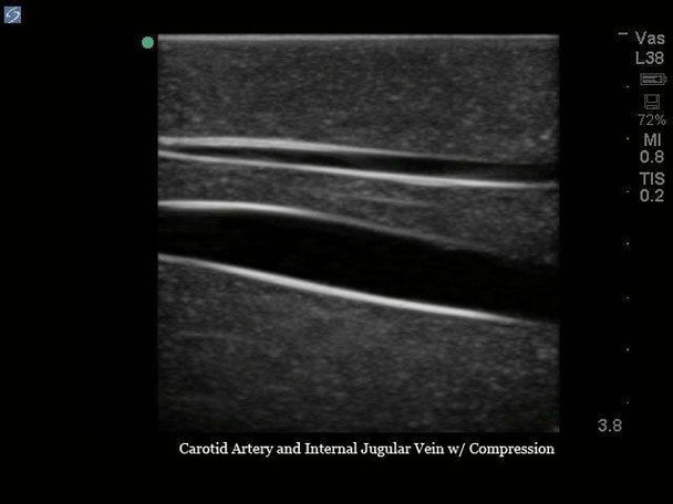 Gen II Ultrasound Central Line Training Model Replacement Tissue Insert