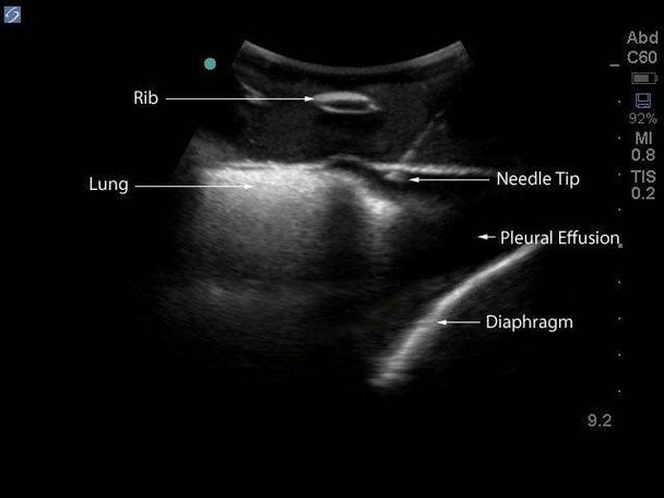 Midscapular Thoracentesis Ultrasound Training Model