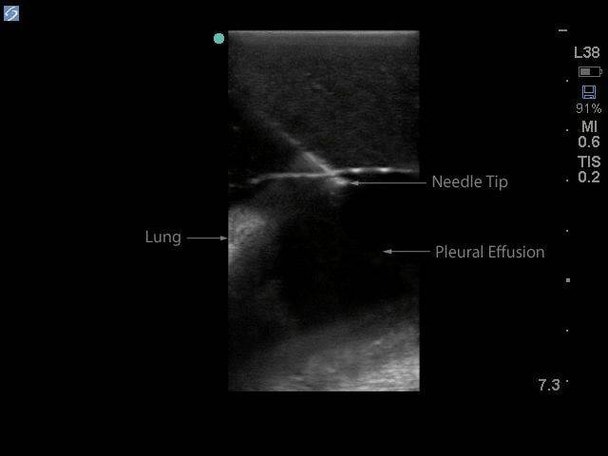Midscapular Thoracentesis Ultrasound Training Model