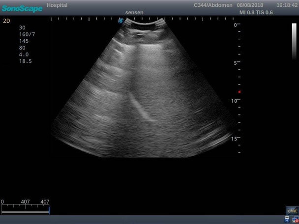 Anatomy Lab Thoracentesis Ultrasound Training Model
