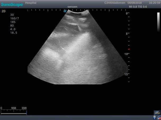 Anatomy Lab Thoracentesis Ultrasound Training Model