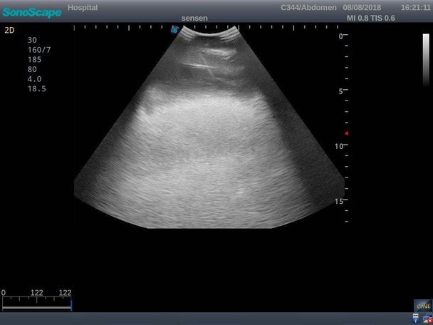 Anatomy Lab Thoracentesis Ultrasound Training Model