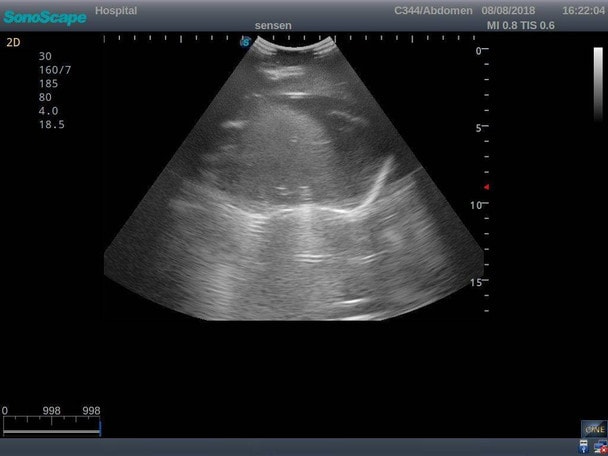 Anatomy Lab Thoracentesis Ultrasound Training Model