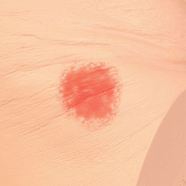 Seymour II Wound Care Model