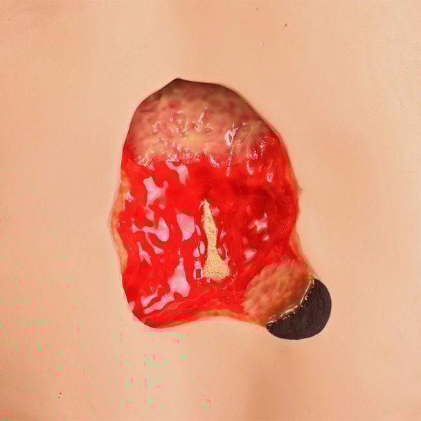 Seymour II Wound Care Model